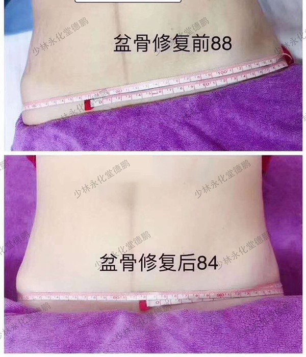 少林永化堂產(chǎn)后項目-骨盆修復(fù)